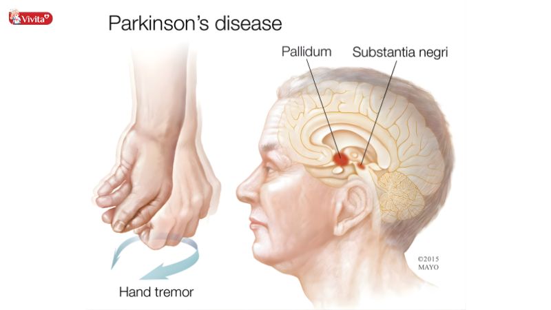 Tổn thương thần kinh