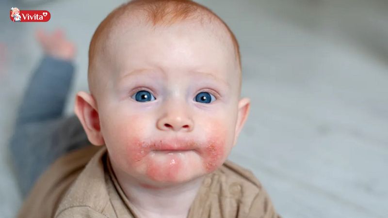 trẻ bị dị ứng thức ăn