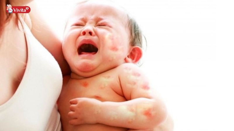 Triệu chứng nặng