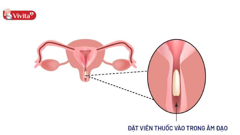 viên đặt phụ khoa trị nấm ngứa