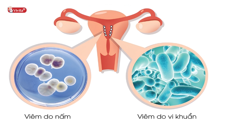Tăng khả năng viêm nhiễm phụ khoa