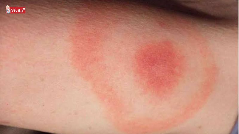 côn trùng đốt làm mẩn đỏ ngứa ngáy