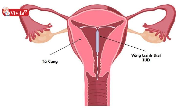 chi phí đặt vòng tránh thai
