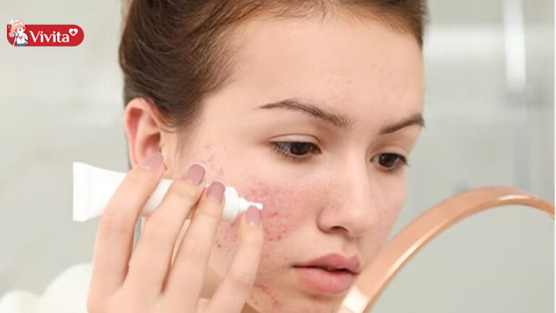 kem trị mụn của nhật