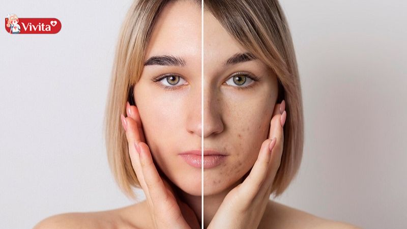 kem trị mụn của nhật