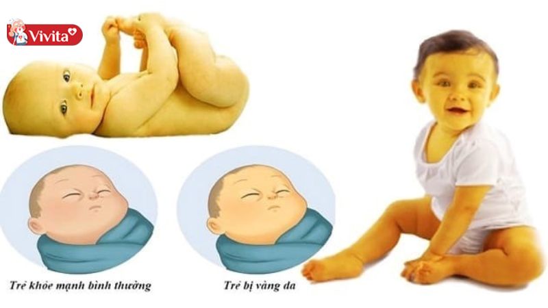 Trẻ vàng da có dấu hiệu nhận biết rõ ràng