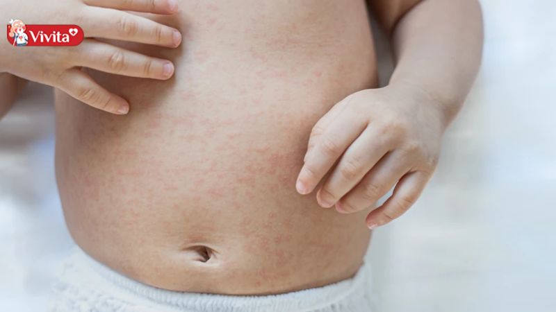 Cần chăm sóc trẻ ốm cẩn thận để ngừa phát ban sau sốt