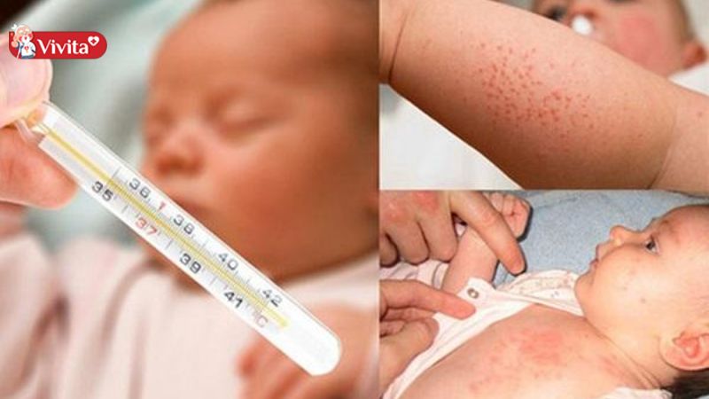 trẻ bị phát ban sau sốt cần kiêng gì