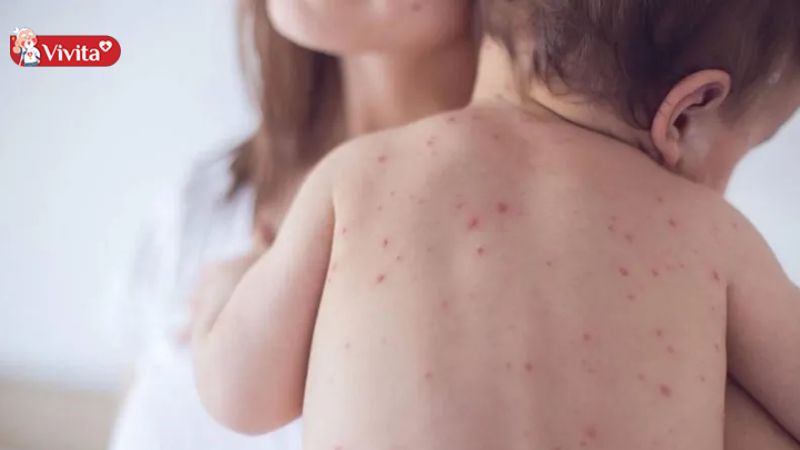 Sau sốt nên tránh mặc quần áo quá dày, bó sát cho trẻ dễ bị phát ban nặng