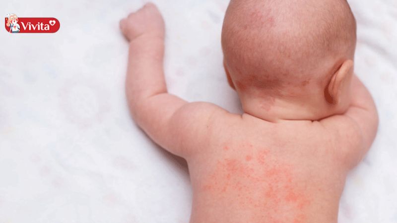 trẻ bị phát ban sau sốt cần kiêng gì