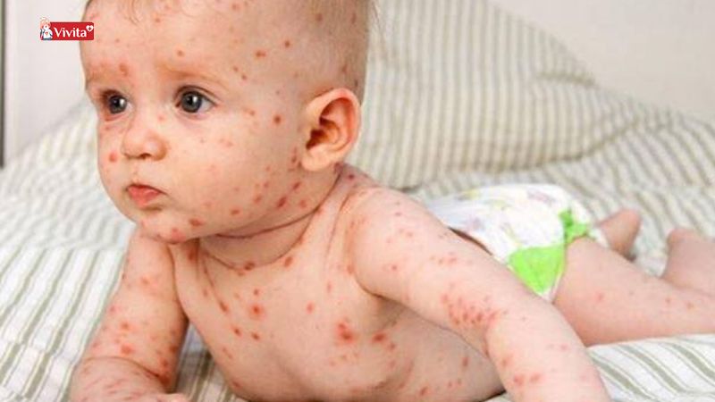 trẻ bị sởi tắm lá được lá gì