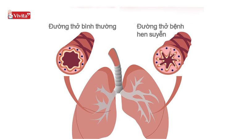 trẻ bị bệnh hen suyễn